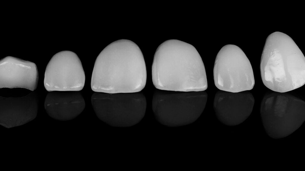 cosmetic dentist Loveland dental bonding in Loveland